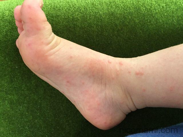 手足口病の発疹（足）